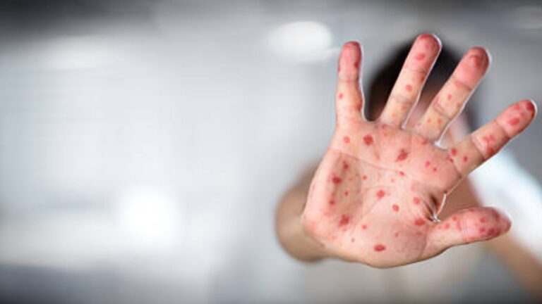 Chickenpox outbreak in Kerala more than 6 thousand cases were reported 1