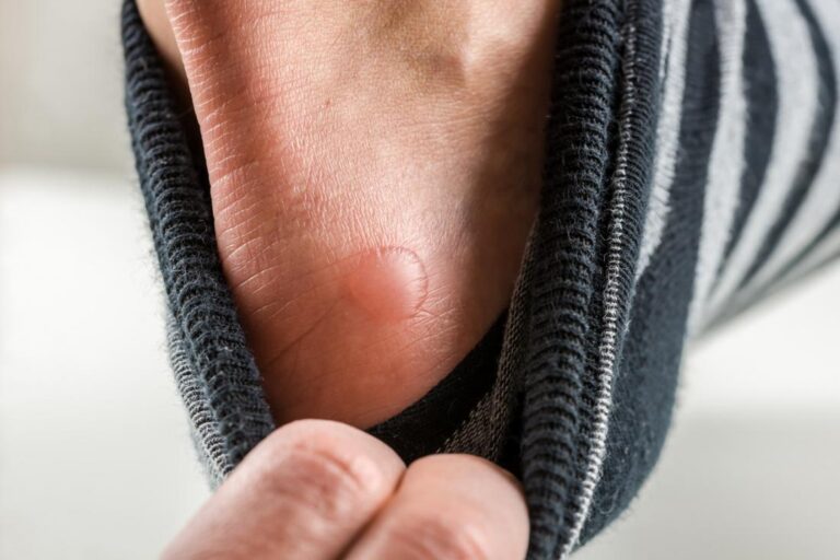 Do you also get frequent blisters? So don't take it lightly, these five serious illnesses can happen.