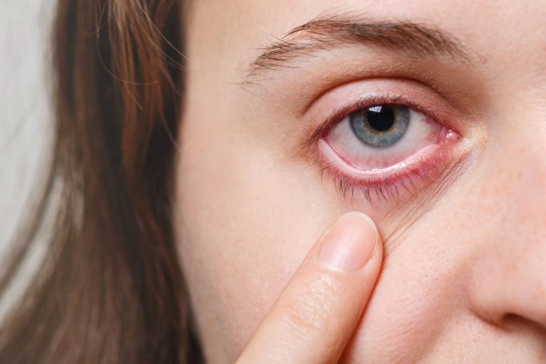 Eye Irritation Do your eyes get irritated in summer So do this simple task